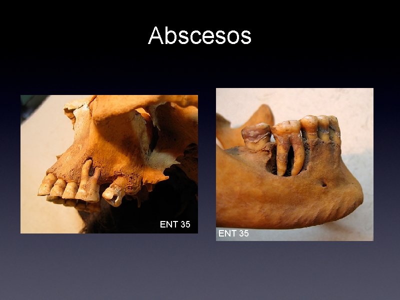 Abscesos ENT 35 
