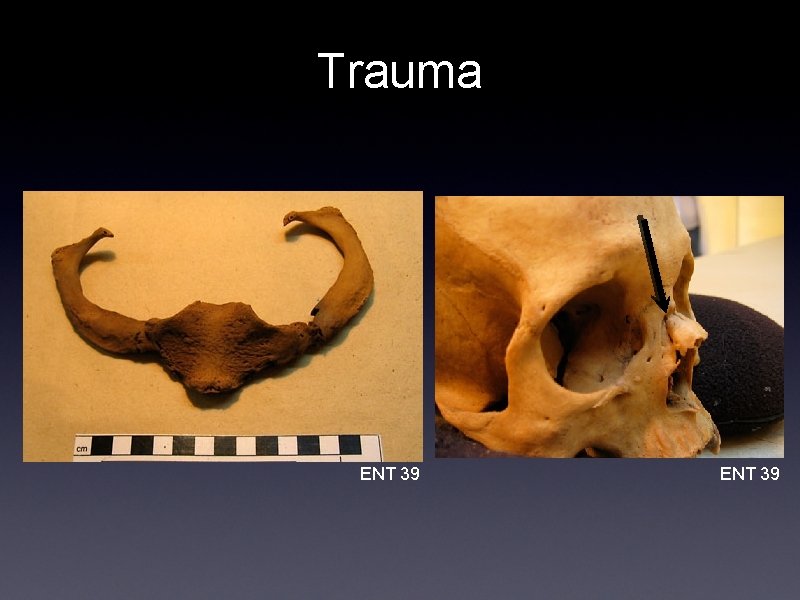 Trauma ENT 39 