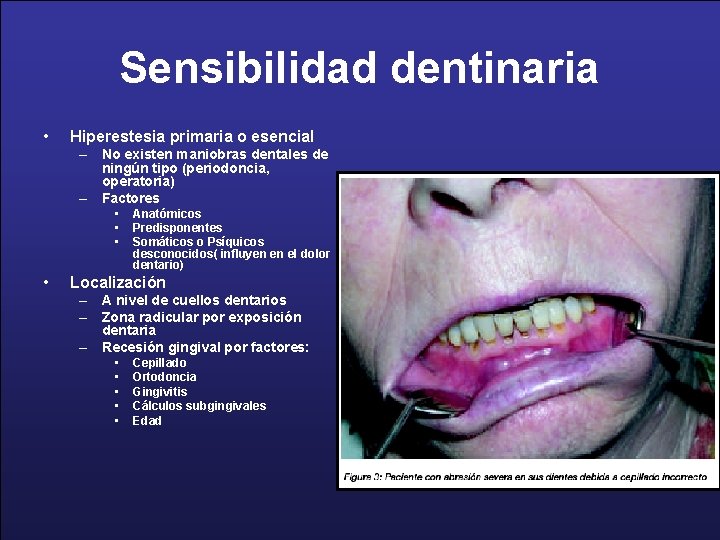 Sensibilidad dentinaria • Hiperestesia primaria o esencial – No existen maniobras dentales de ningún