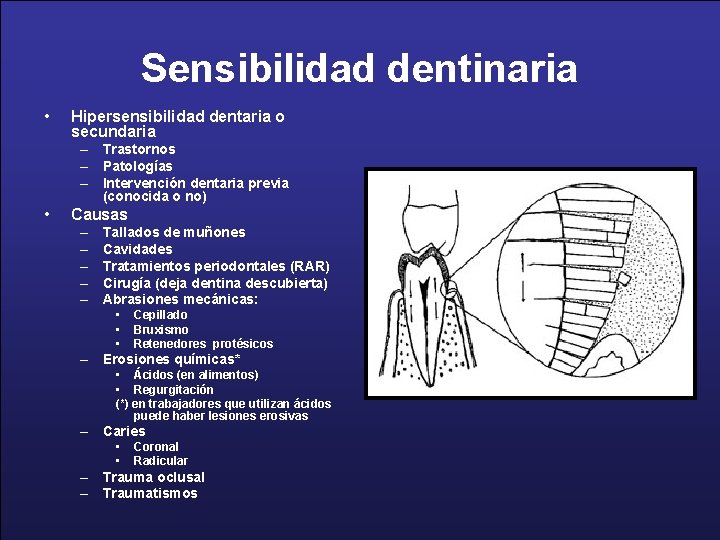 Sensibilidad dentinaria • Hipersensibilidad dentaria o secundaria – Trastornos – Patologías – Intervención dentaria