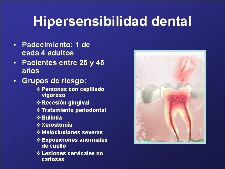 Hipersensibilidad dental • Padecimiento: 1 de cada 4 adultos • Pacientes entre 25 y