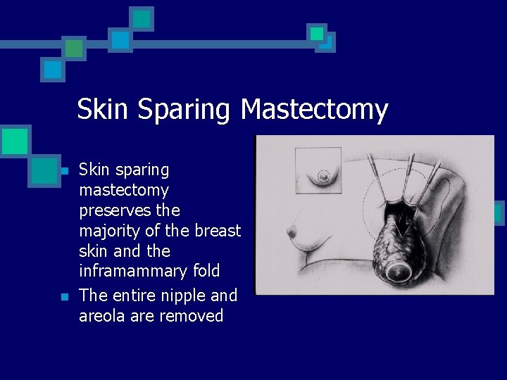 Skin Sparing Mastectomy n n Skin sparing mastectomy preserves the majority of the breast