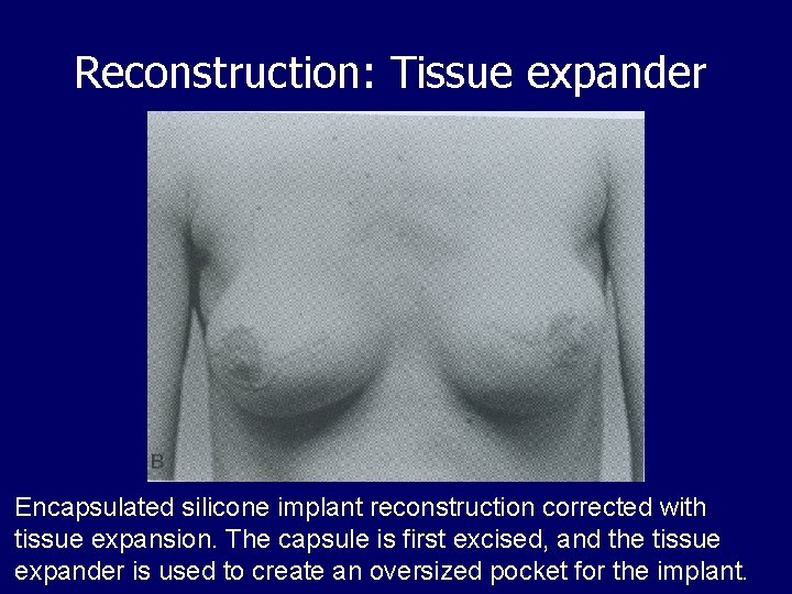 Reconstruction: Tissue expander Encapsulated silicone implant reconstruction corrected with tissue expansion. The capsule is