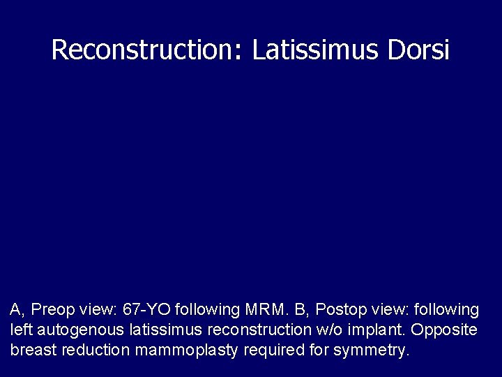Reconstruction: Latissimus Dorsi A, Preop view: 67 -YO following MRM. B, Postop view: following