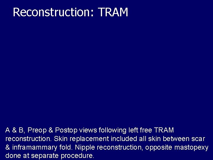 Reconstruction: TRAM A & B, Preop & Postop views following left free TRAM reconstruction.