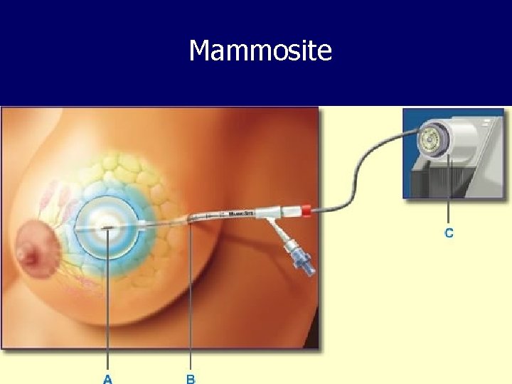 Mammosite 