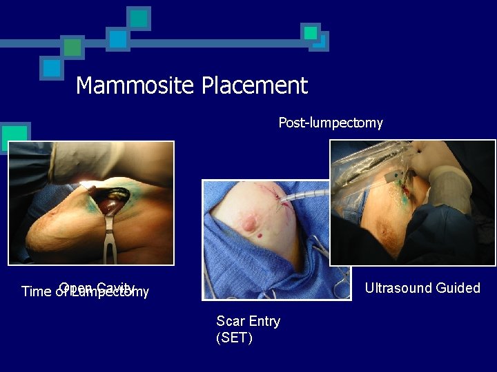 Mammosite Placement Post-lumpectomy Open Cavity Time of Lumpectomy Ultrasound Guided Scar Entry (SET) 