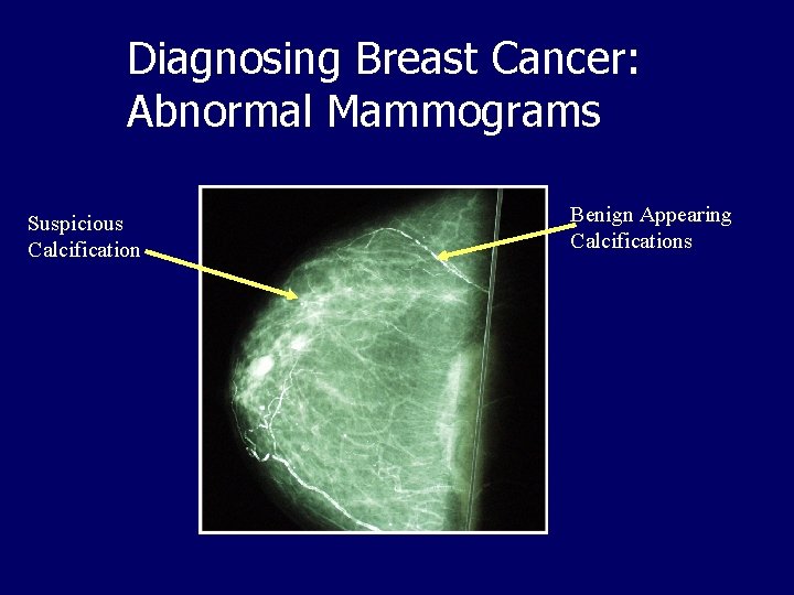 Diagnosing Breast Cancer: Abnormal Mammograms Suspicious Calcification Benign Appearing Calcifications 