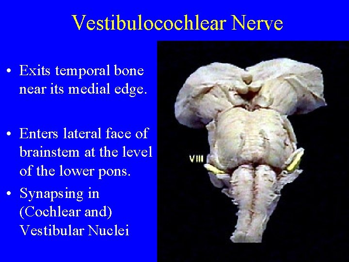 Vestibulocochlear Nerve • Exits temporal bone near its medial edge. • Enters lateral face