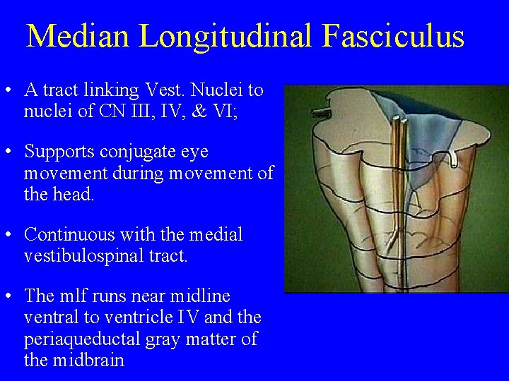 Median Longitudinal Fasciculus • A tract linking Vest. Nuclei to nuclei of CN III,