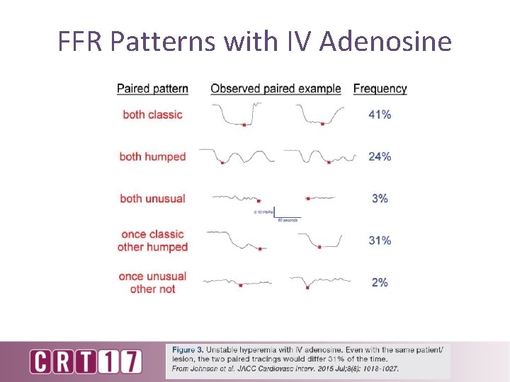 FFR Patterns with IV Adenosine Fearon, W. Circ. Cardiovascular. Interv. 2015; j 8: doi: