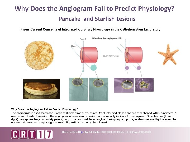 Why Does the Angiogram Fail to Predict Physiology? Pancake and Starfish Lesions From: Current