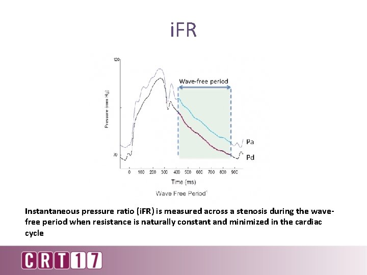 i. FR Instantaneous pressure ratio (i. FR) is measured across a stenosis during the