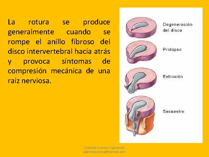 La rotura se produce generalmente cuando se rompe el anillo fibroso del disco intervertebral