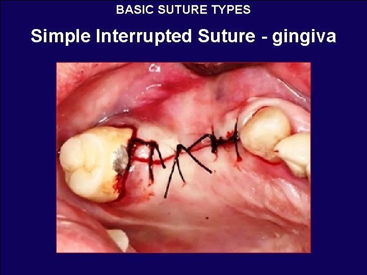 BASIC SUTURE TYPES Simple Interrupted Suture - gingiva 