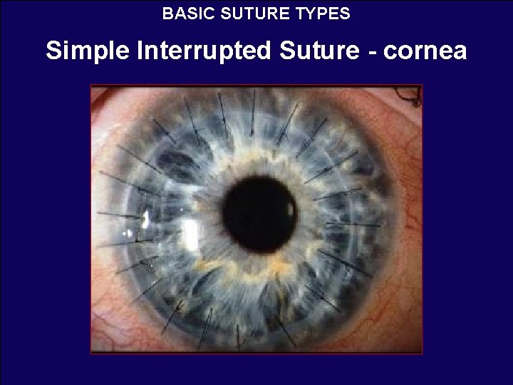 BASIC SUTURE TYPES Simple Interrupted Suture - cornea 