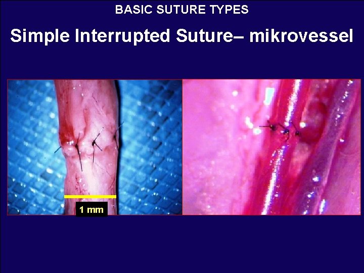 BASIC SUTURE TYPES Simple Interrupted Suture– mikrovessel 1 mm 