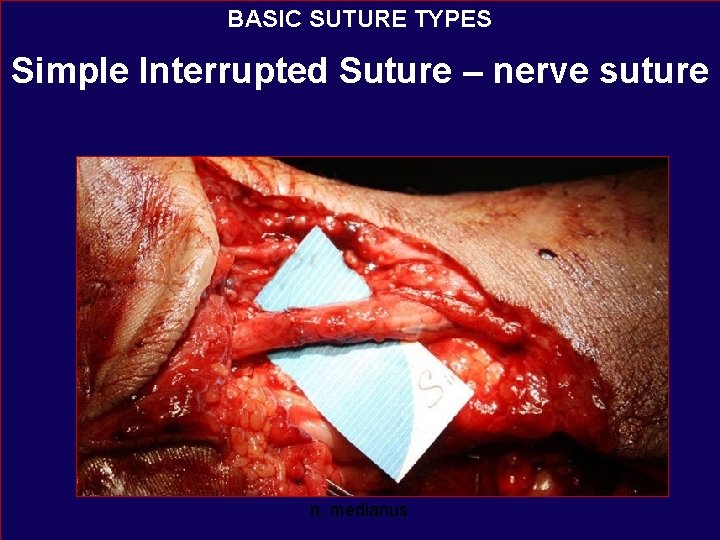 BASIC SUTURE TYPES Simple Interrupted Suture – nerve suture n. medianus 