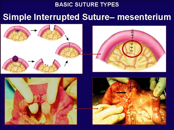 BASIC SUTURE TYPES Simple Interrupted Suture– mesenterium 