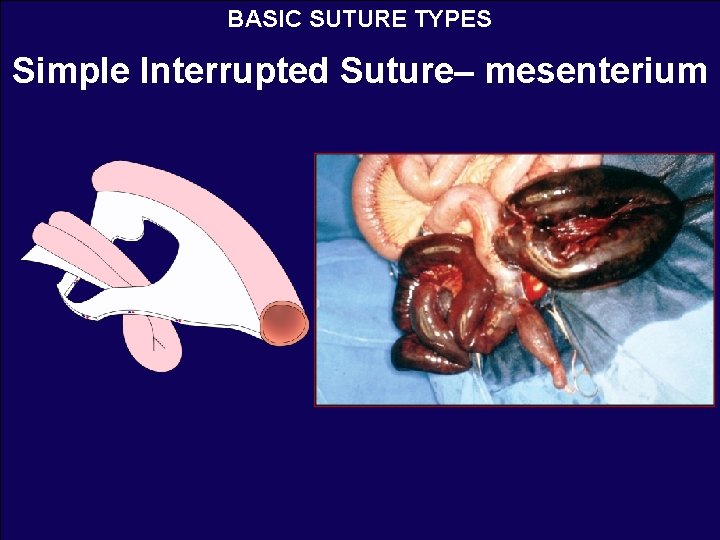 BASIC SUTURE TYPES Simple Interrupted Suture– mesenterium 