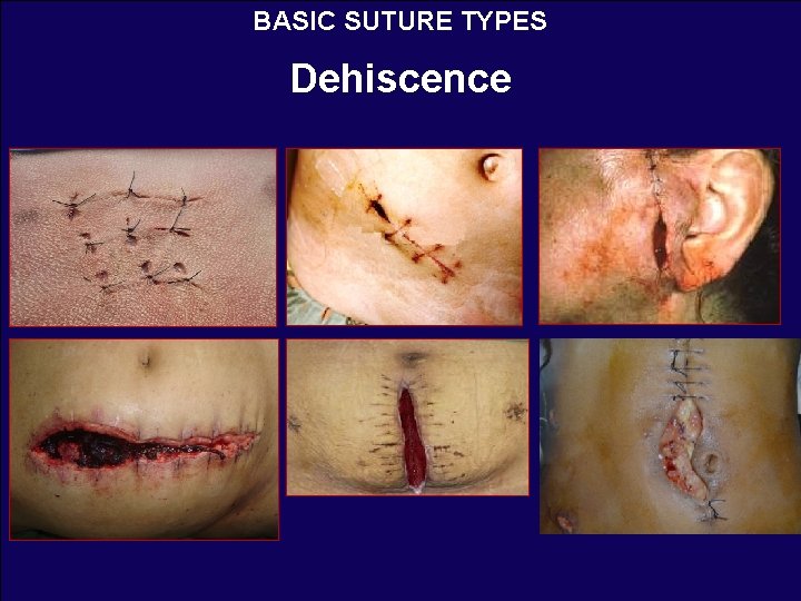 BASIC SUTURE TYPES Dehiscence 