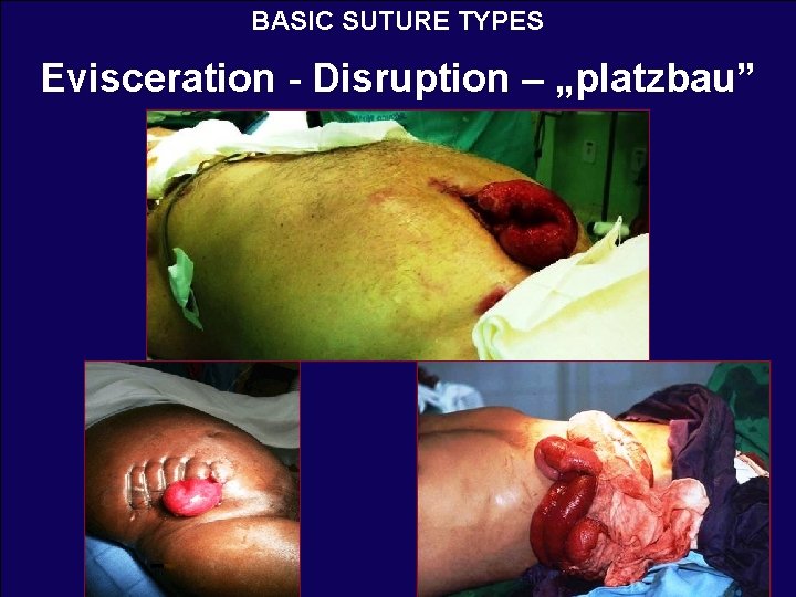 BASIC SUTURE TYPES Evisceration - Disruption – „platzbau” 