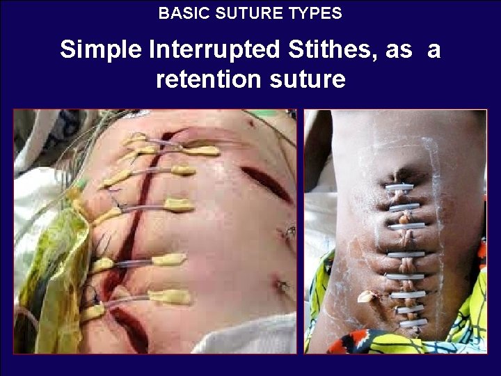 BASIC SUTURE TYPES Simple Interrupted Stithes, as a retention suture 
