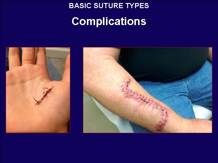 BASIC SUTURE TYPES Complications 
