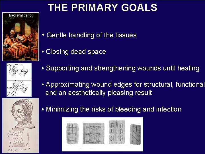 THE PRIMARY GOALS Medieval period • Gentle handling of the tissues • Closing dead
