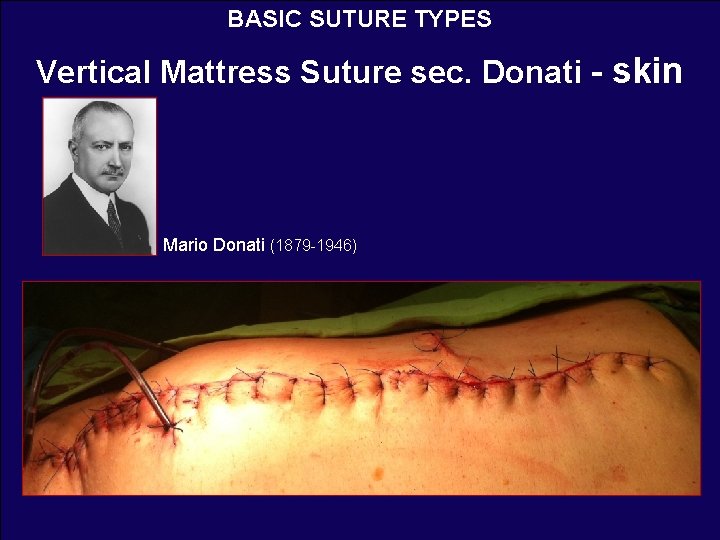 BASIC SUTURE TYPES Vertical Mattress Suture sec. Donati - skin Mario Donati (1879 -1946)