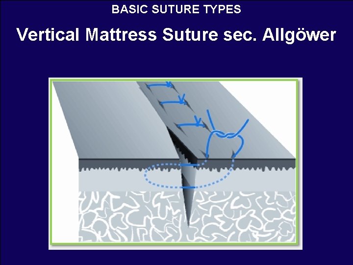 BASIC SUTURE TYPES Vertical Mattress Suture sec. Allgöwer 