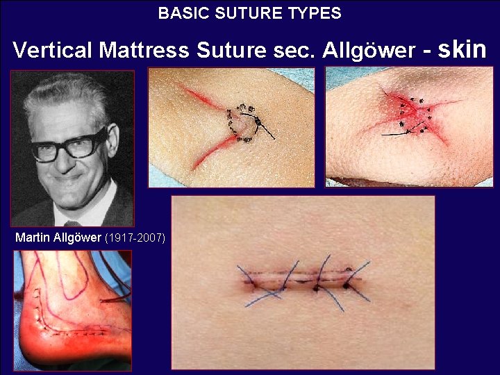 BASIC SUTURE TYPES Vertical Mattress Suture sec. Allgöwer - skin Martin Allgöwer (1917 -2007)
