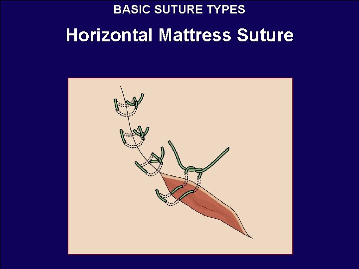 BASIC AND SPECIAL SUTURING TECHNIQUES IN SURGERY Andrea