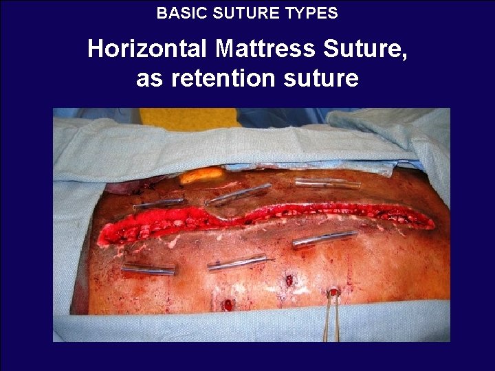BASIC SUTURE TYPES Horizontal Mattress Suture, as retention suture 