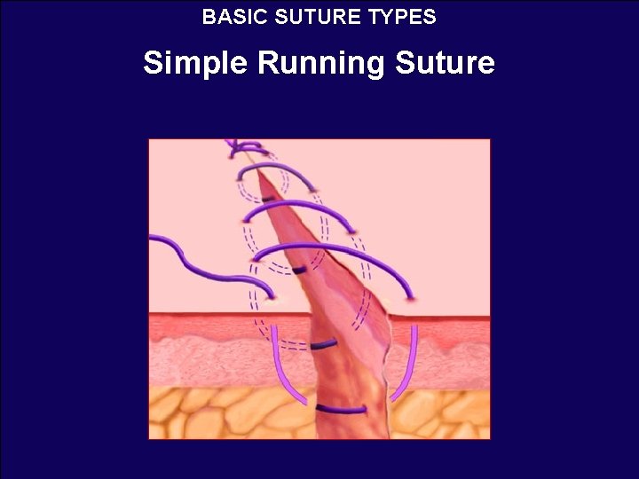 BASIC SUTURE TYPES Simple Running Suture 