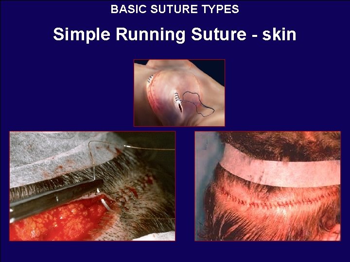 BASIC SUTURE TYPES Simple Running Suture - skin 