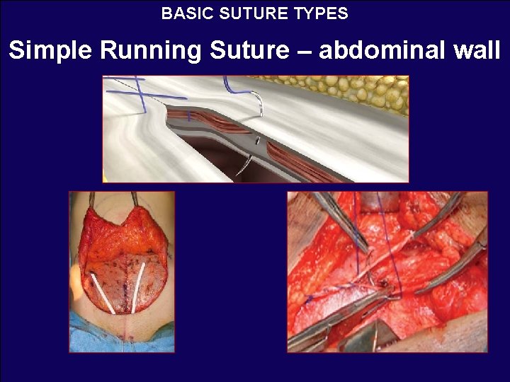BASIC SUTURE TYPES Simple Running Suture – abdominal wall 