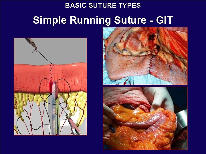 BASIC SUTURE TYPES Simple Running Suture - GIT 