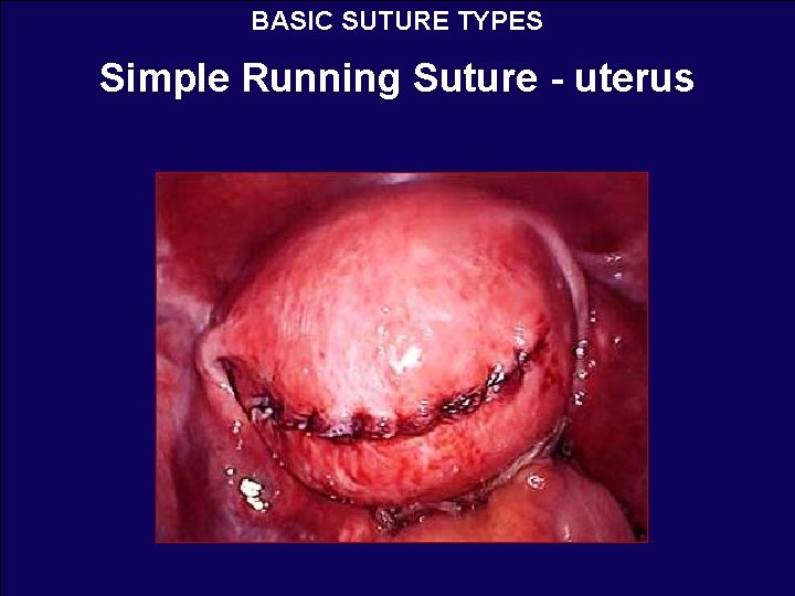 BASIC SUTURE TYPES Simple Running Suture - uterus 