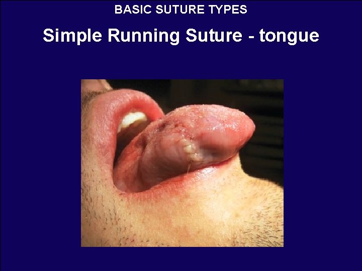 BASIC SUTURE TYPES Simple Running Suture - tongue 