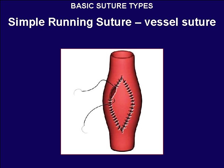 BASIC SUTURE TYPES Simple Running Suture – vessel suture 