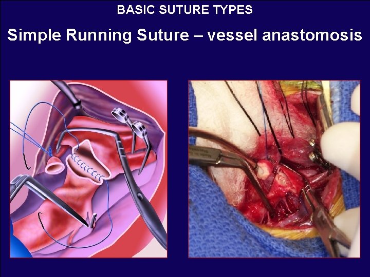 BASIC SUTURE TYPES Simple Running Suture – vessel anastomosis 