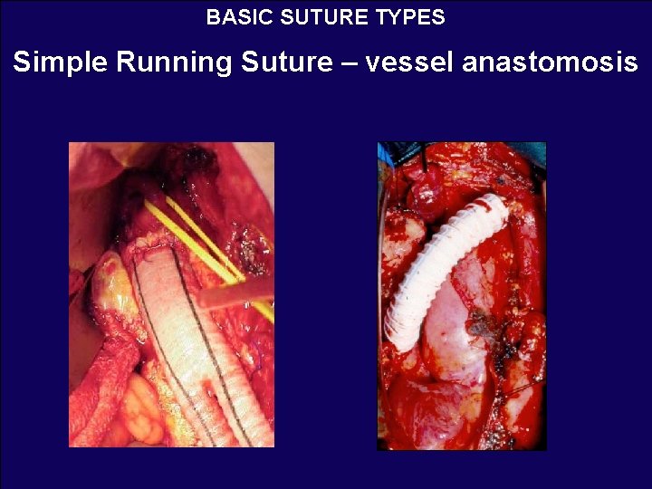 BASIC SUTURE TYPES Simple Running Suture – vessel anastomosis 