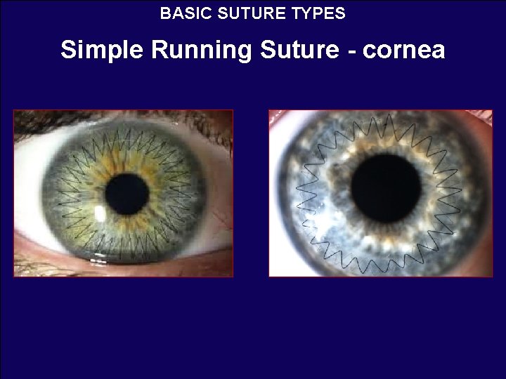 BASIC SUTURE TYPES Simple Running Suture - cornea 