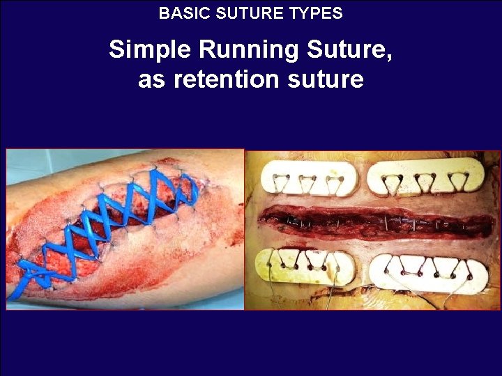 BASIC SUTURE TYPES Simple Running Suture, as retention suture 