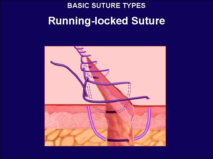 BASIC SUTURE TYPES Running-locked Suture 