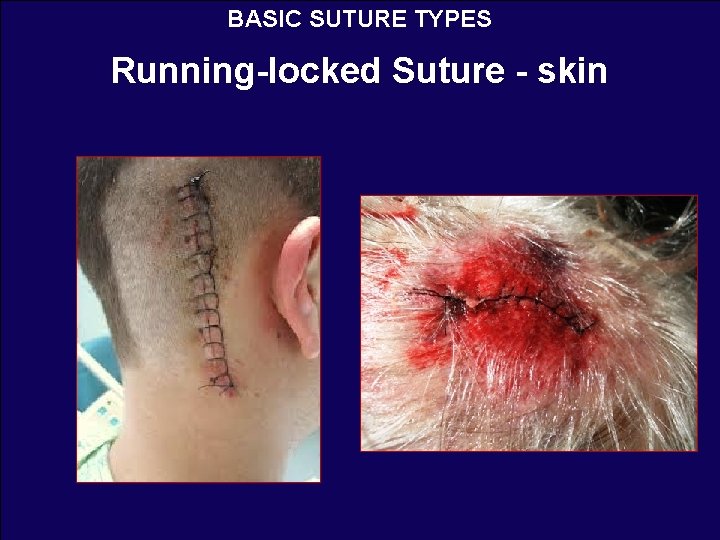 BASIC SUTURE TYPES Running-locked Suture - skin 