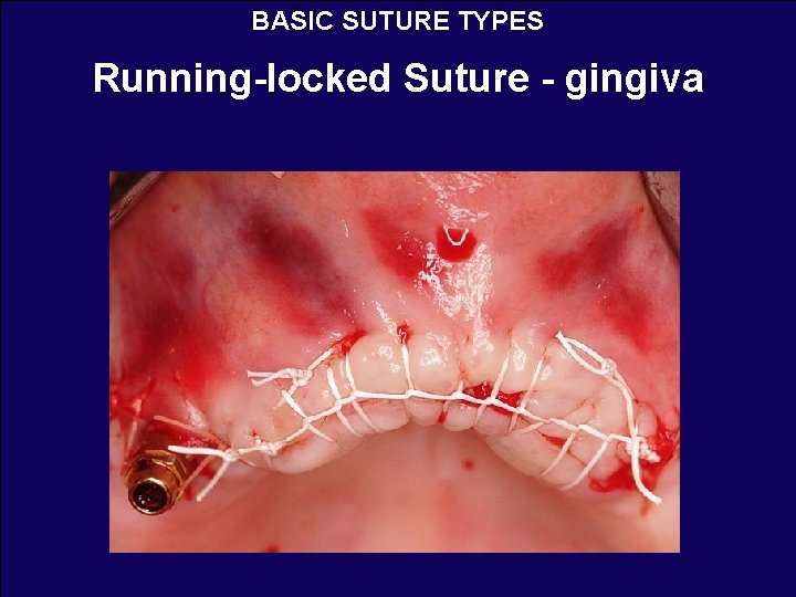 BASIC SUTURE TYPES Running-locked Suture - gingiva 