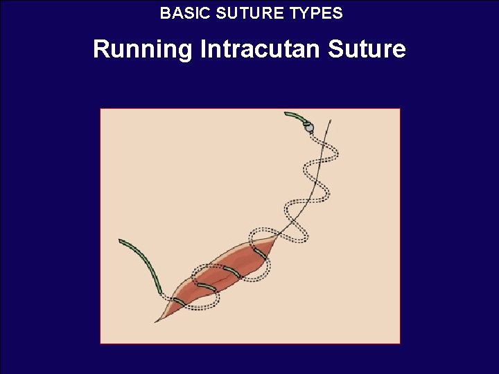 BASIC SUTURE TYPES Running Intracutan Suture 