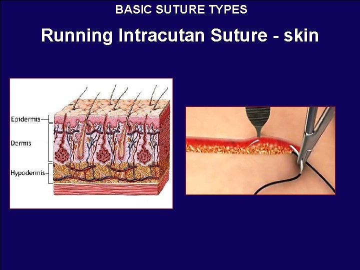 BASIC SUTURE TYPES Running Intracutan Suture - skin 